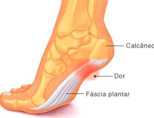 Fascite Plantar e Artrite