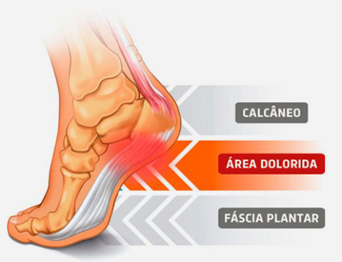Esporão do Calcâneo e Artrite