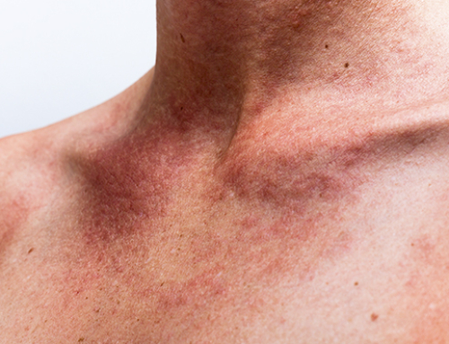 Polimiosite e Dermatomiosite