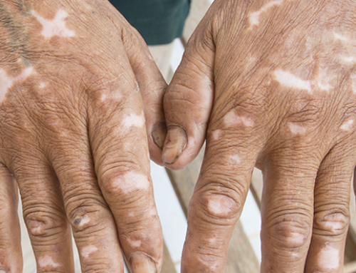 Compreendendo a Esclerodermia (Esclerose Sistêmica Progressiva)