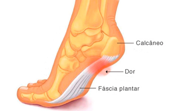 Fascite Plantar e Artrite