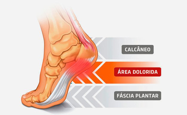 Esporão do Calcâneo e Artrite