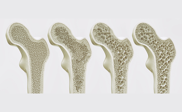 Tratamento da Osteoporose